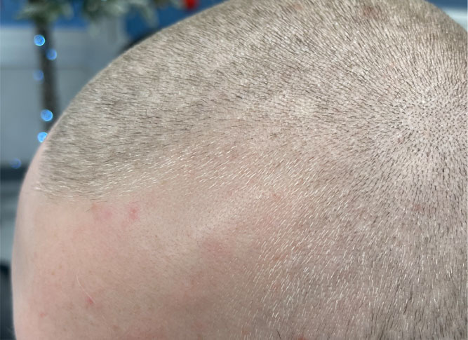 Scalp Micropigmentation Before